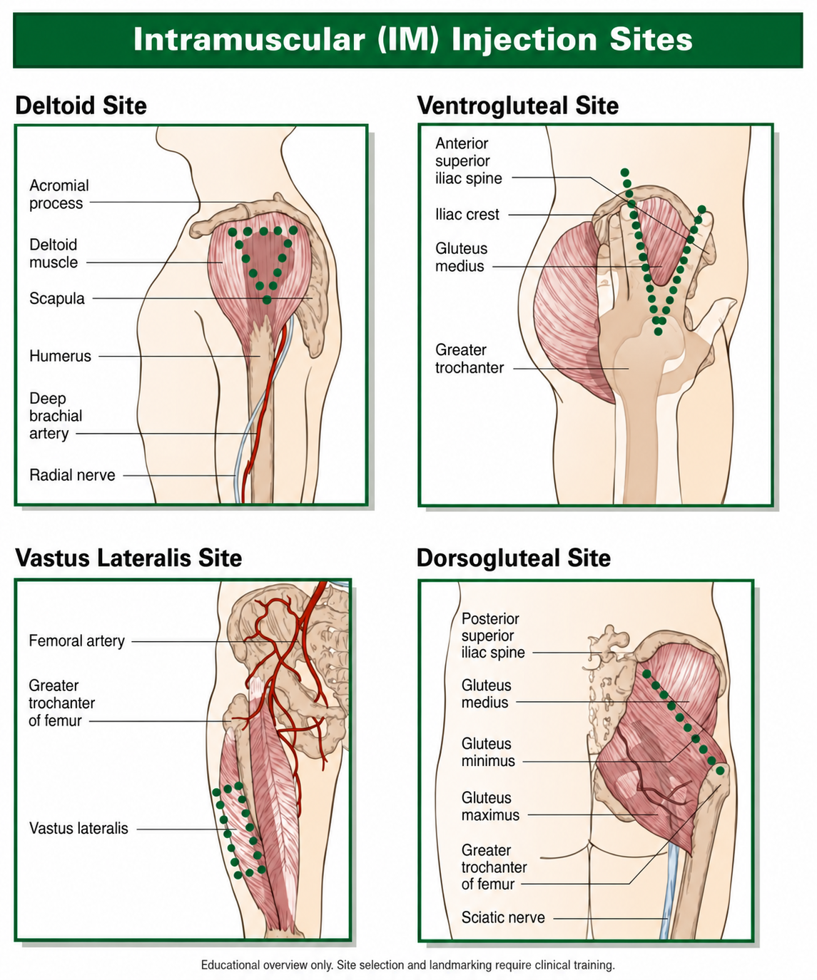 Anatomical diagrams of the four intramuscular injection sites: deltoid, ventrogluteal, vastus lateralis and dorsogluteal, with landmarks and nerves labelled.